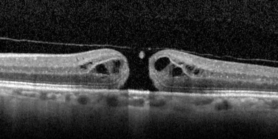 OCT de un agujero macular de espesor completo antes de la cirugía, con el vítreo todavía adherido