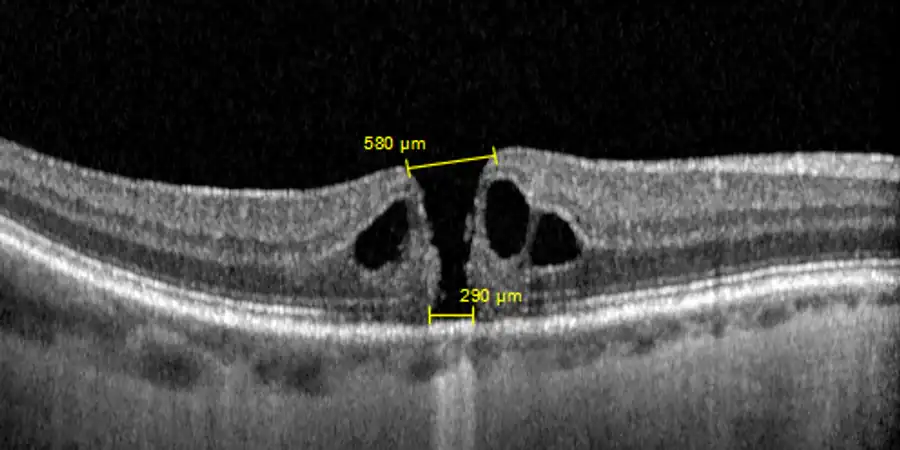 OCT de un agujero macular antes de la cirugía, con sus diámetros medidos: 580 y 290 micras
