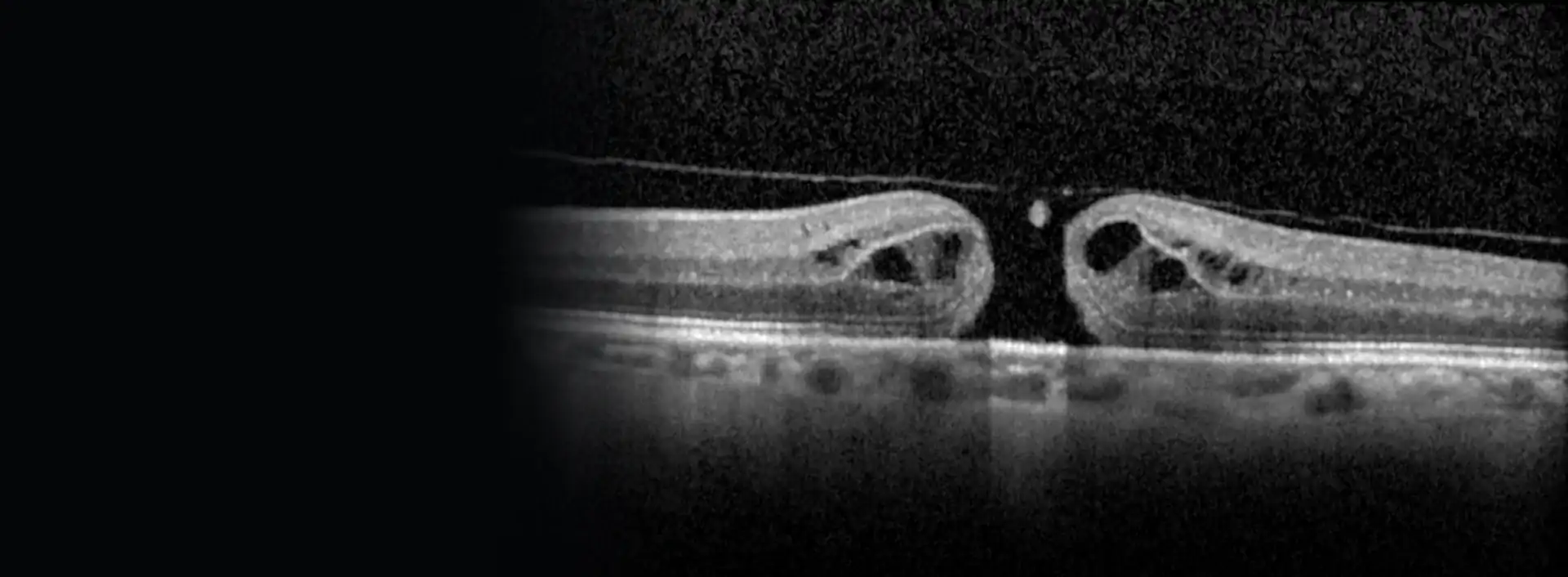 Tomografía OCT de un agujero macular antes de la cirugía