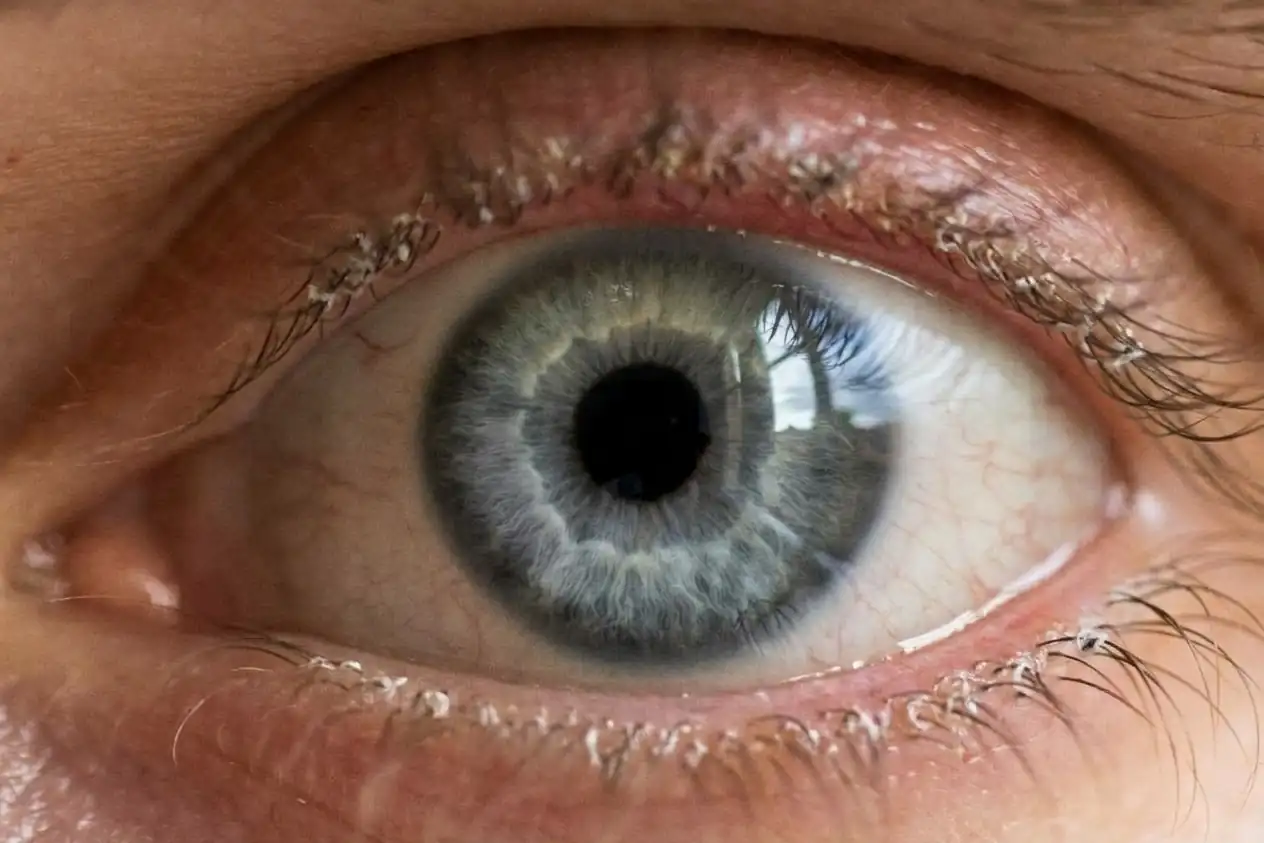 Primer plano de un ojo con escamas y costras en la base de las pestañas y el borde de los párpados enrojecido, como en una blefaritis