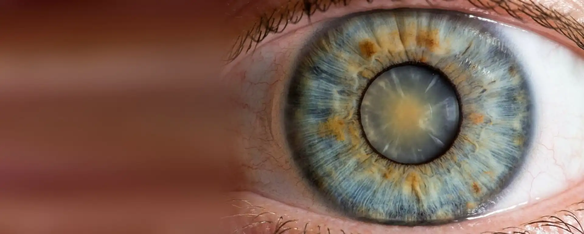 Ojo con la pupila dilatada y el cristalino opaco y blanquecino por una catarata