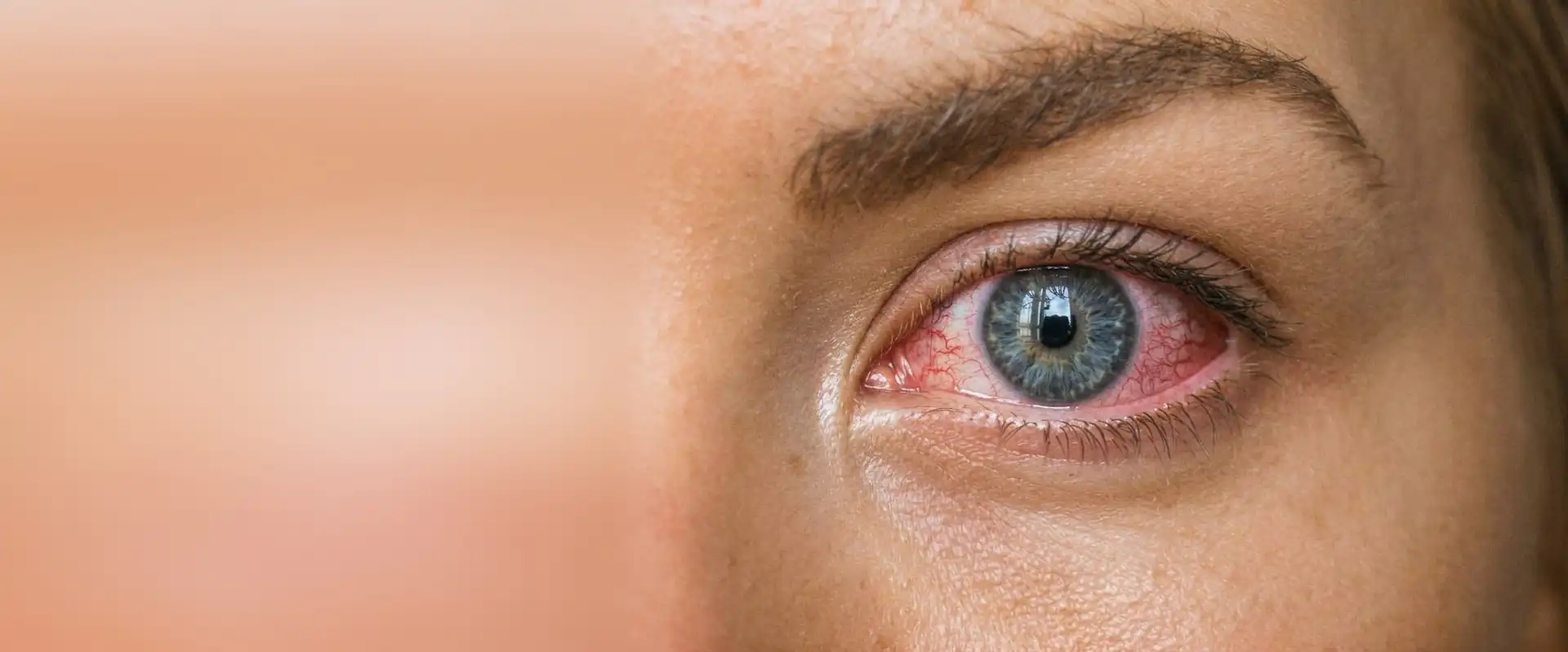 Ojo enrojecido, con los vasos de la conjuntiva dilatados, como en una conjuntivitis