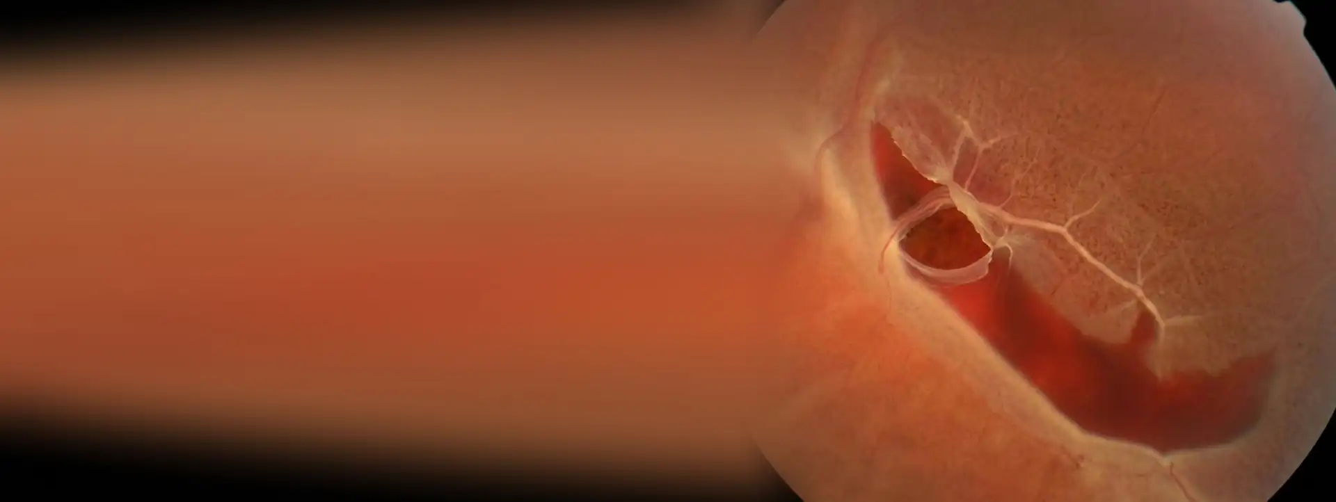 Fondo de ojo con un desgarro de retina en herradura y una hemorragia junto a él