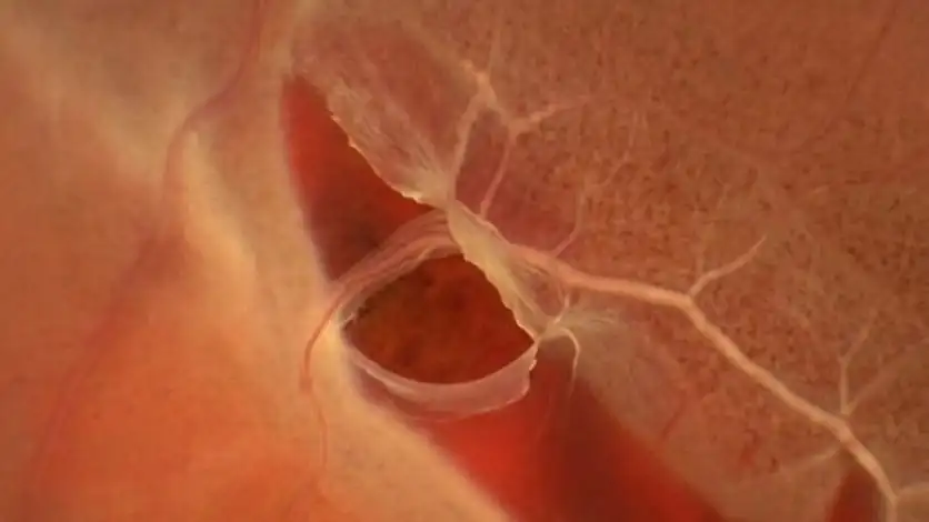Fondo de ojo con un desgarro de retina en herradura y una hemorragia junto a él