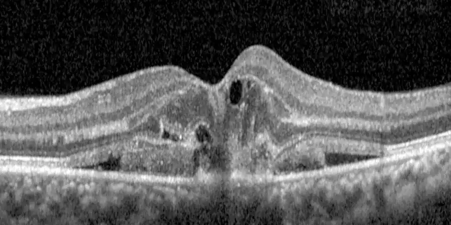 Tomografía OCT de DMAE húmeda con quistes y líquido bajo la retina, antes del tratamiento