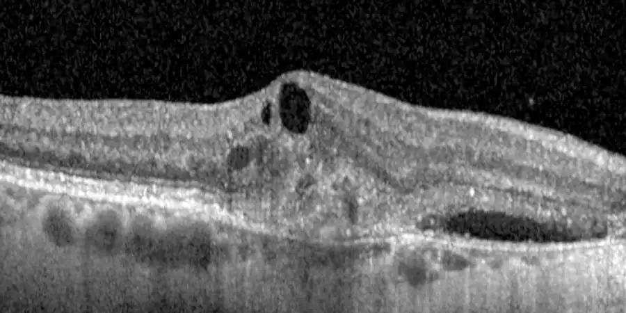 Tomografía OCT de DMAE húmeda con quistes grandes y líquido bajo la retina, antes del tratamiento