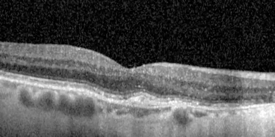 La misma retina después de las inyecciones: los quistes y el líquido han desaparecido