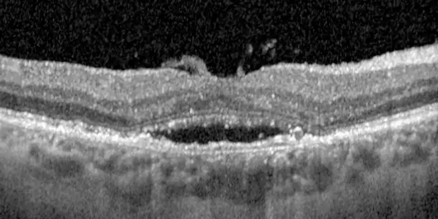 Tomografía OCT de DMAE húmeda con una bolsa de líquido bajo la retina, antes del tratamiento