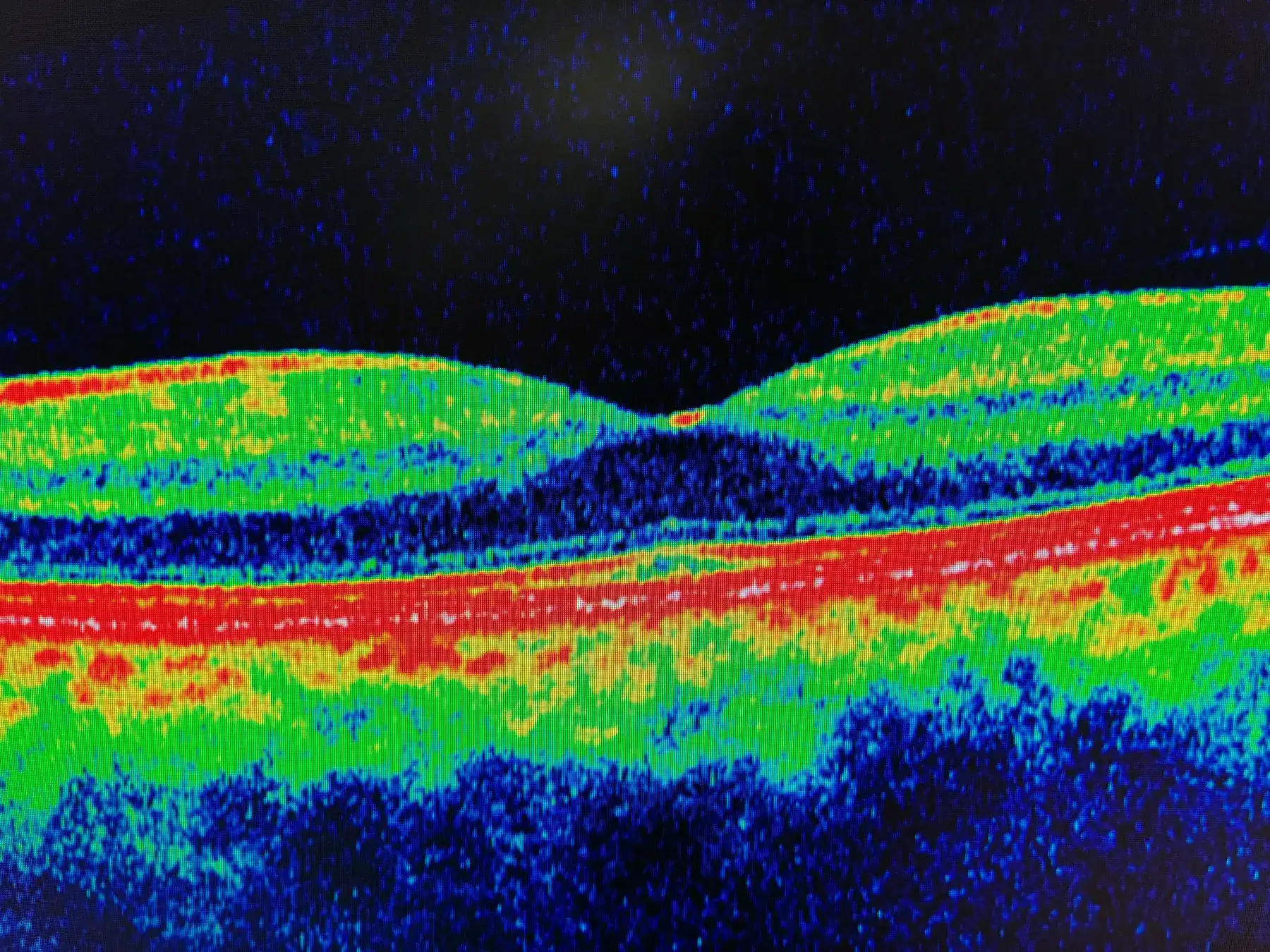 Corte de tomografía de coherencia óptica (OCT) de la mácula en falsos colores, hecho en la consulta, donde se distinguen las capas de la retina y la depresión central de la fóvea
