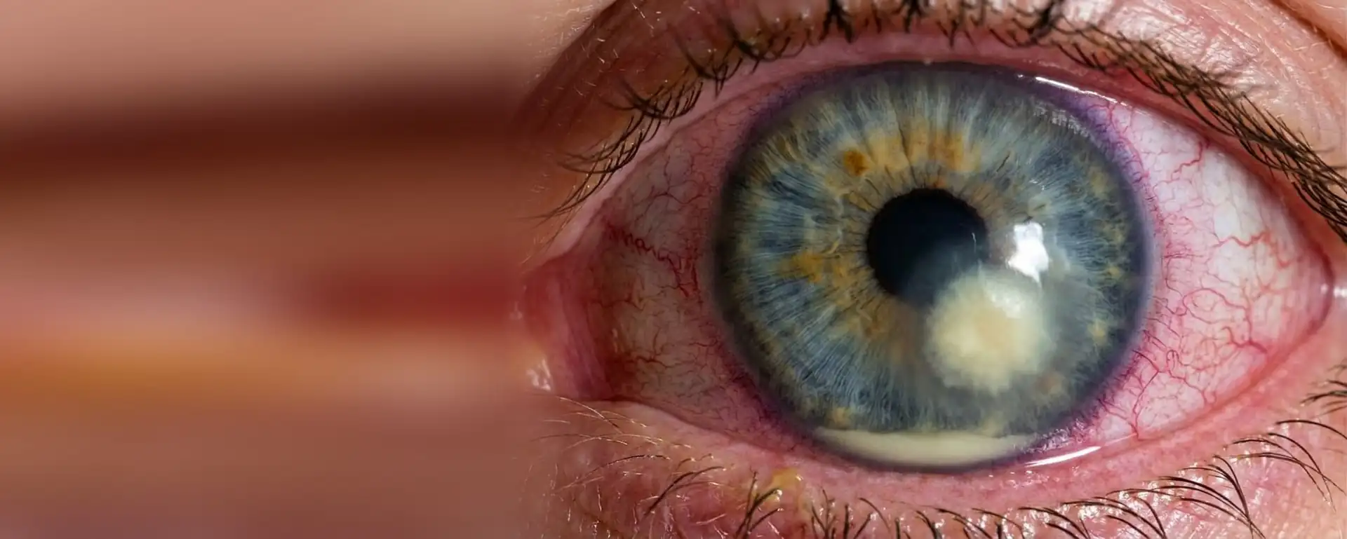 Ojo rojo con un absceso blanquecino en la córnea y pus en la cámara anterior
